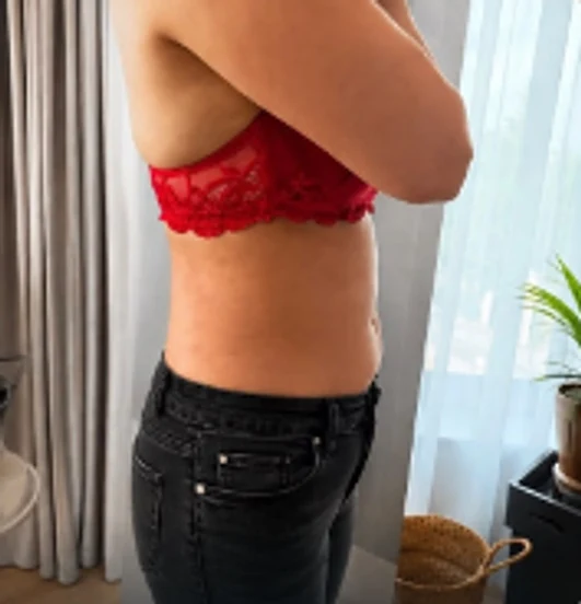 Abdomen și talie, vedere laterală, după seria de tratamente