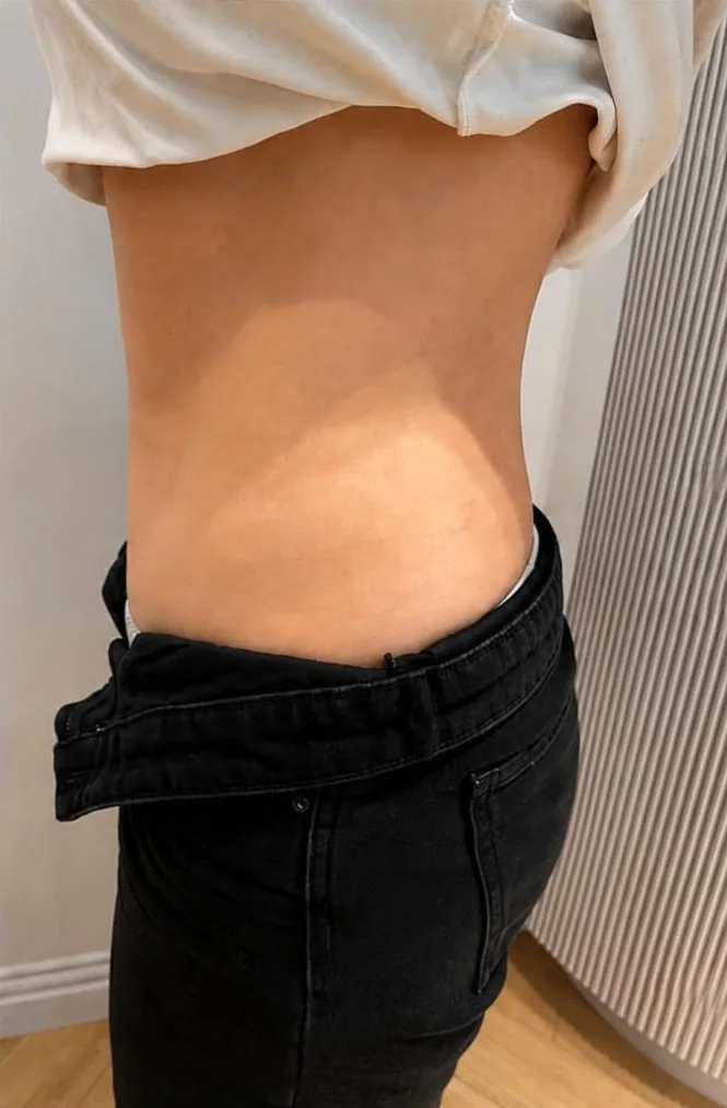 Abdomen și talie, vedere laterală, după seria de tratamente