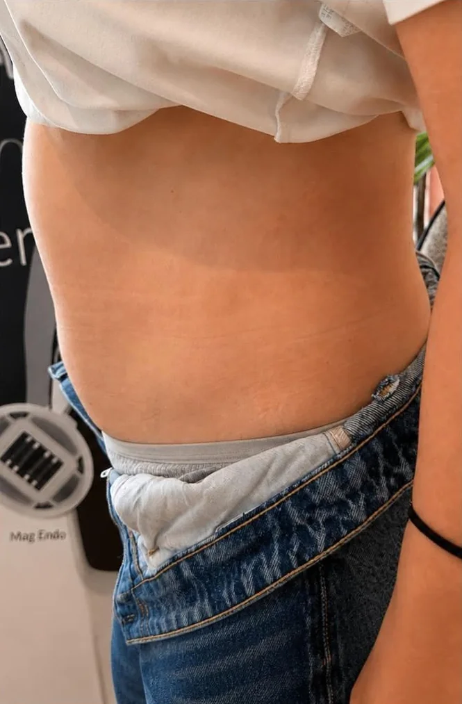 Abdomen și talie, vedere laterală, înainte de tratament