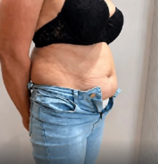 Abdomen și talie, vedere laterală, înainte de tratament